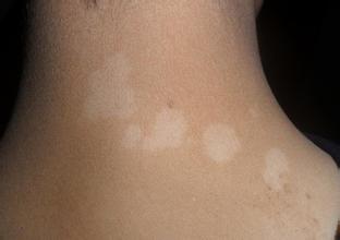 ���粡�����ǰ����Щ֢״