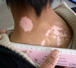 ���缲���ķ�����������Щ֢״�ص���