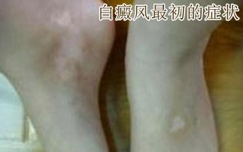 ���粻ͬ���͵�֢״��������Щ